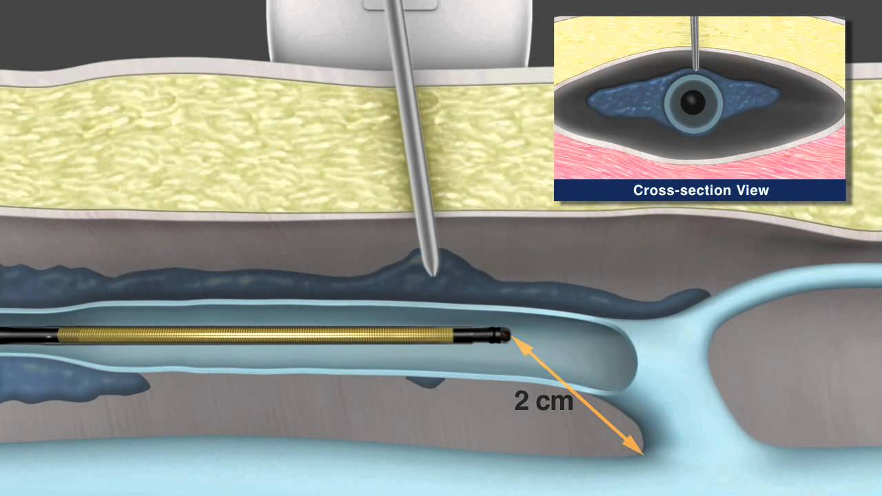 Ablación por radiofrecuencia El Segundo CA