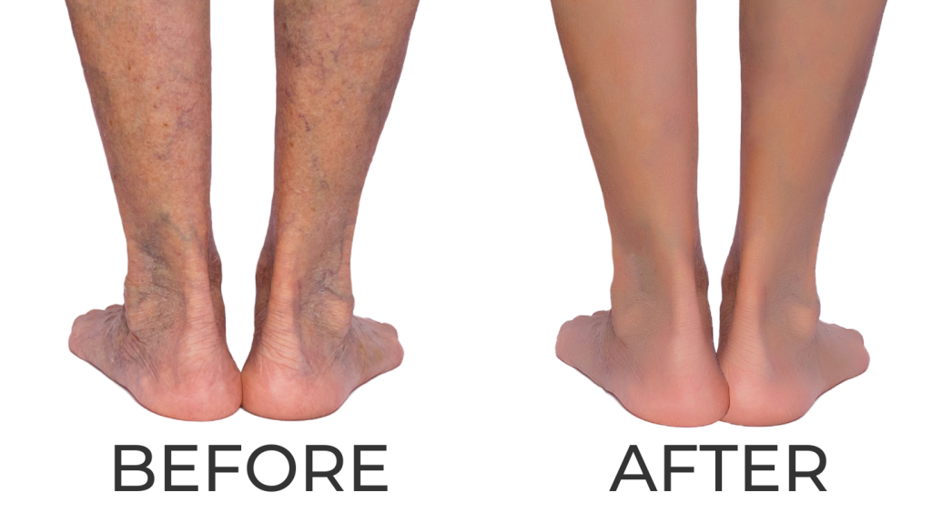 Sclerotherapy and Spider Veins in Charlotte, Vein Experts