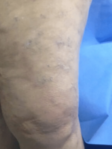 varicose-veins-after-1