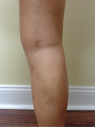 varicose-veins-after-3