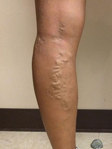 varicose-veins-before-6
